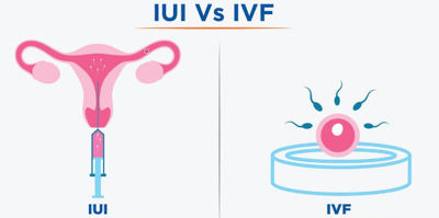 IUI & IVF: Phương pháp điều trị vô sinh nào thích hợp hơn?